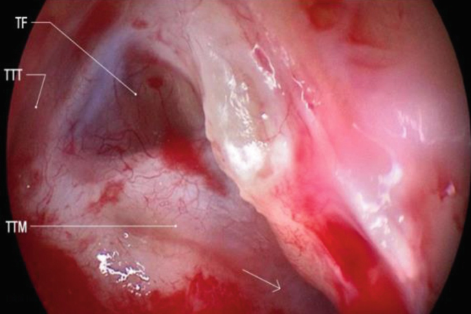 A photograph of the internal ear exhibits the following labels. T F, T T T, and T T M. An arrow at the bottom center is marked.