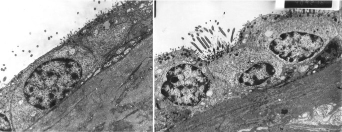 Two electron micrographs of epithelial cells. Both micrographs have irregular, dark, clustered masses with uneven surfaces and dotted structures on them. In the right micrograph, a shadowy structure is on the bottom right.