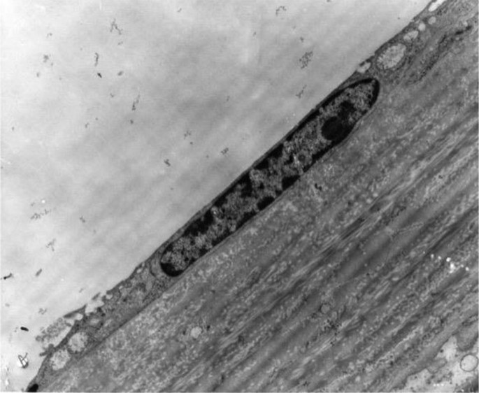 An electron micrograph of squamous epithelium. It has a diagonal structure with bubble-like gaps and a dark patch of mass in the center. The bottom right has a uniformly lined surface.