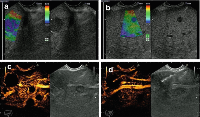 4 sets of E U S images of the liver. The presence of dark-shaded, dense, and opaque regions in the liver indicates the tumor.