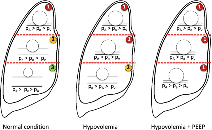 A set of 3 illustrations of the lung. The first schematic illustrates normal condition with top zone 1, middle zone 2, and bottom zone 3. The second schematic illustrates top and middle zone 1 and bottom zone 2. The third illustrates all three sections in zone 1.