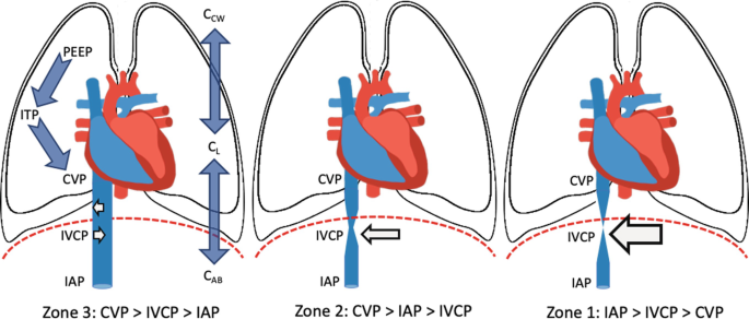 A schematic has 3 illustrations of the pulmonary circulation. In the first illustration, P E E P and I T P contribute to C V P. I V C P is balanced and I A P is less. In the second illustration, I V C P is the least leading to constricting the I V C. In the third illustration, I A P is the lowest.