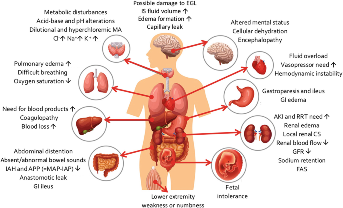 A schematic of the human body and the different vital organs and the effects of saline infusion on them. These include possible damage to E G L, altered mental status, fluid overload, gastroparesis, A K I and R R T need increased, fetal intolerance, weakness or numbness, and abdominal distension.