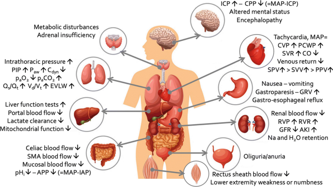 A schematic of the important effects of increased I A P on different organs. The organs and their respective effects are labeled around an illustration of the human body.
