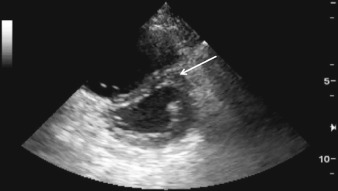An ultrasound scan of the displacement of the interventricular septum toward the left ventricle is highlighted by an arrow.