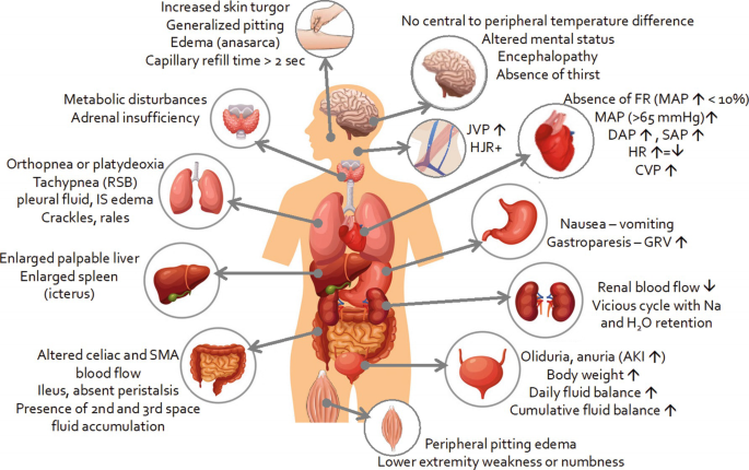 An anatomical diagram of the human body lists the various clinical signs and symptoms of hypervolemia in the different organs. Some of them are as follows. Increased skin turgor, a capillary refill time of more than 2 seconds, peripheral pitting edema, decreased renal blood flow, and increased G R V.