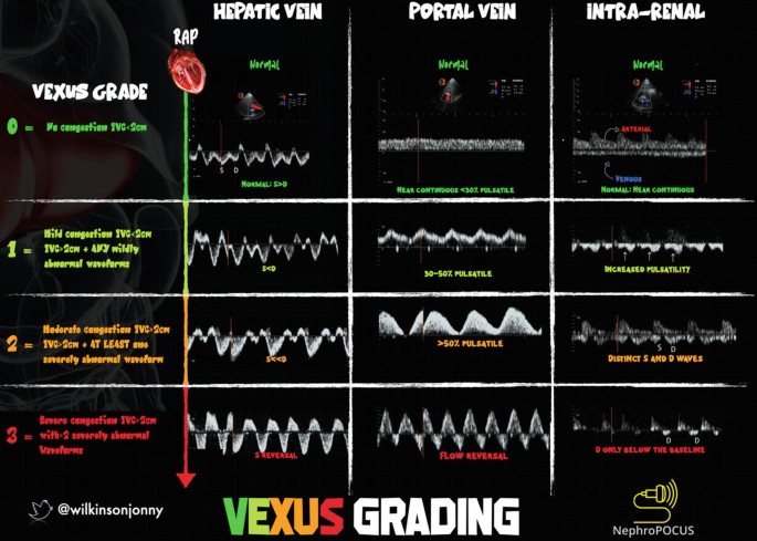 A chart titled Vexus grading lists the vexus grades for the hepatic vein, portal vein, and intra-vein in cases of no congestion, mild congestion, moderate congestion, and severe congestion.