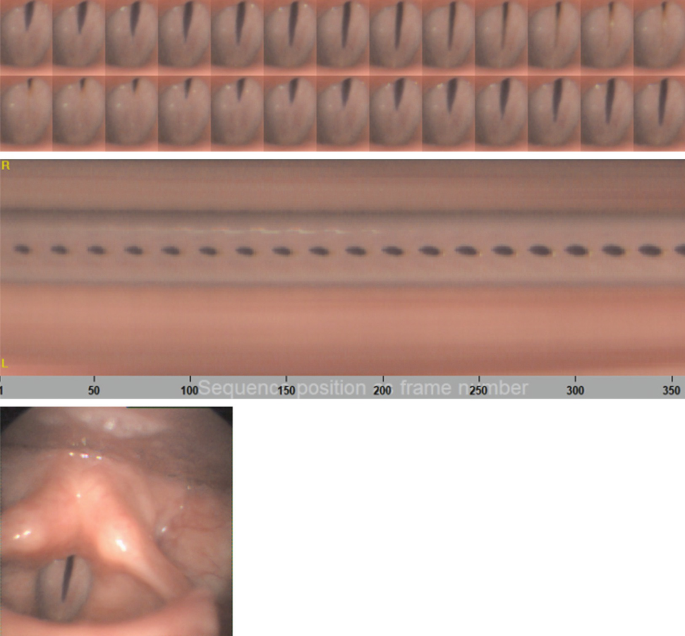 A high-speed video depicts the middle of the post-pubertal stage of girls. It exhibits regular frequency in the vocal folds with slight thickening at the rear. At the bottom, a photo of the surface of the vocal folds with a rear glottal gap is indicated.