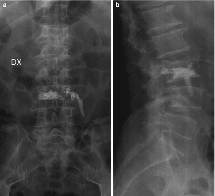 2 X-rays of the vertebral column in the anteroposterior and lateral planes in A and B, respectively. A dense and light-shaded opacity present in the intervertebral space indicates the presence of a cementing material.