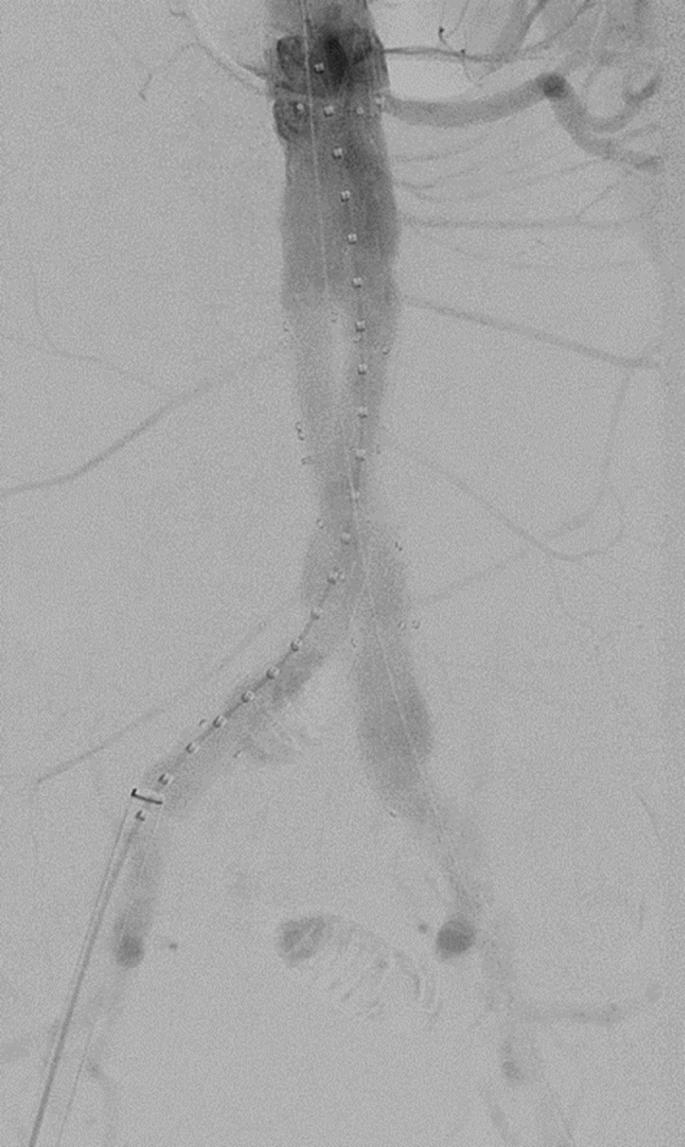 An angiographic image of the abdominal aorta exhibits the swelling and rupture of the aortic wall in a dark shade.