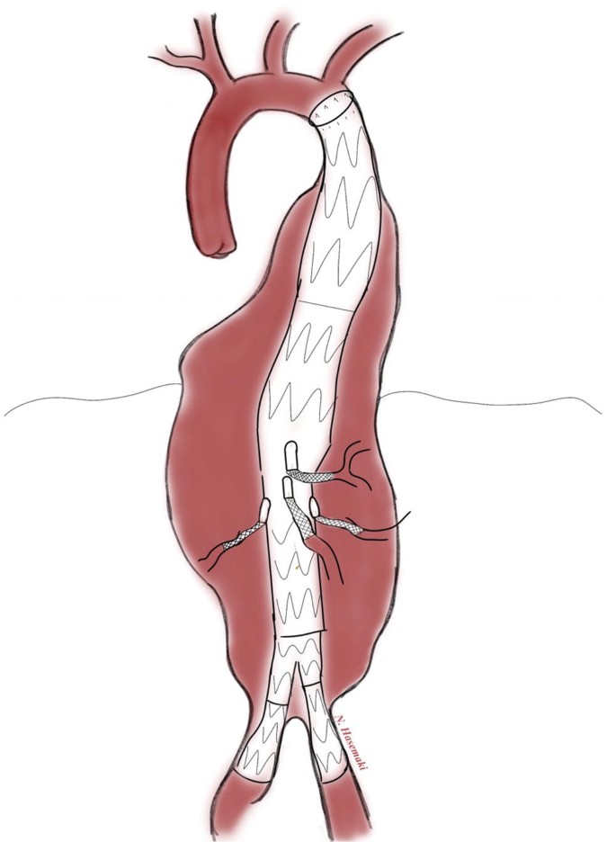 An illustration of the bulging aorta with a branched endograft secured.