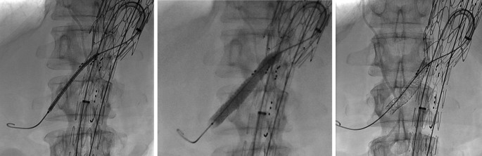3 radiographs of the lumbar spine with an installed wire like a stent and a branched endograft.