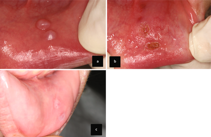 3 intra-oral photos. 2 small round nodules are present on the inner mucosal wall of the lower lip. The nodules are surgically removed, leaving marks on the skin. The follow-up photo indicates a completely healed wound.