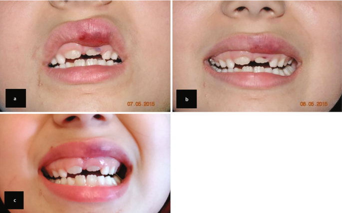 3 photos of the teeth of a patient. The upper lip is swollen, and the teeth on the upper jaw have abnormal shapes with irregular spacing. The post-operative photo illustrates that the swelling is removed with a small bruise on the lip. The follow-up photo indicates a completely healed lip.