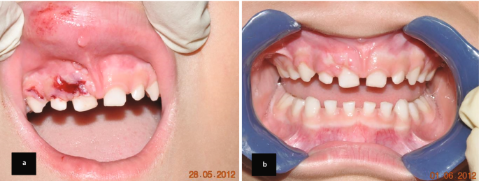 2 intra-oral photos. The teeth are irregularly spaced, and a dark-shaded ulcer is present on the gum. The postoperative photo indicates a healed gum after the removal of the ulcer.