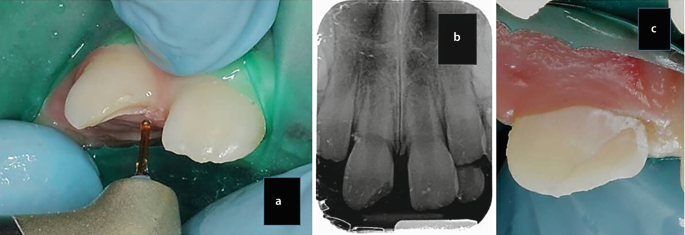 4 photos and 2 radiographs of a broken incisor. In the dental radiograph, the broken part of the teeth is present as a dark-shaded region. After the treatment, the broken part of the incisor is reattached with the fragment. The post-operative radiograph indicates the presence of a complete incisor.