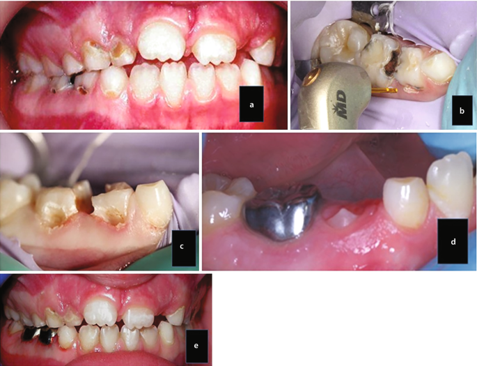 5 intra-oral photographs. Dark-shaded cavities are present at the base of the premolars along with chipped teeth. The teeth affected by cavities are removed, and 2 metallic crowns are implanted on the gum.