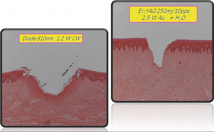 Two illustrations of the cross-section of tissues. They illustrate the crater-shaped incision and the V-shaped incision made by different laser wavelengths of diode 810 nanometers, 1.2 W C W, and E r Y A G 205 mega joules over 10 pulse per second 2.4 W A v plus H 2 O.