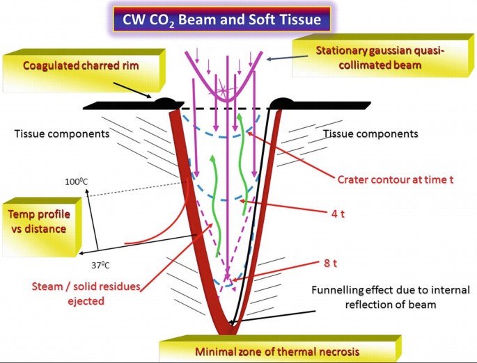 An illustration titled C W C O 2 Beam and Soft Tissue. It illustrates a V-shaped incision created in the tissue. Some of the labels include coagulated charred rim, temp profile versus distance, steam or solid residues ejected and minimal zone of thermal necrosis.