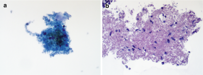 2 microscopic images. A. It depicts a dense cluster of necrotic debris with scattered histiocytes at the center. B. It exhibits light-stained debris scattered with dot spots.