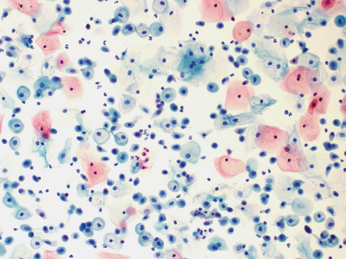 A histological scan of scattered parabasal cells indicates atrophic changes during postpartum.