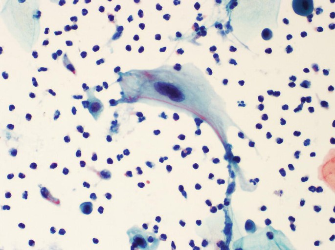 A histological scan of cytoplasmic polychromasia. The cells are heavily stained and appear as large circular structures with enlarged nuclei and ample cytoplasm.