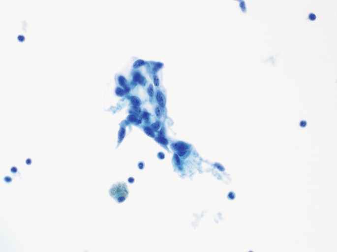 A microscopic image displays a wound that is stained and has a grainy appearance. Multiple single nuclei are scattered all along the cytoplasm.