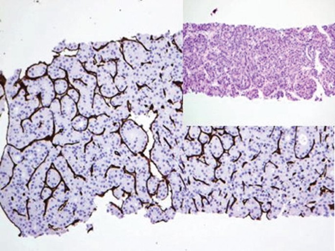 A photomicrograph of normal liver parenchyma highlights sinusoidal cells in hepatocellular carcinoma. An inset micrograph is provided at the top right.