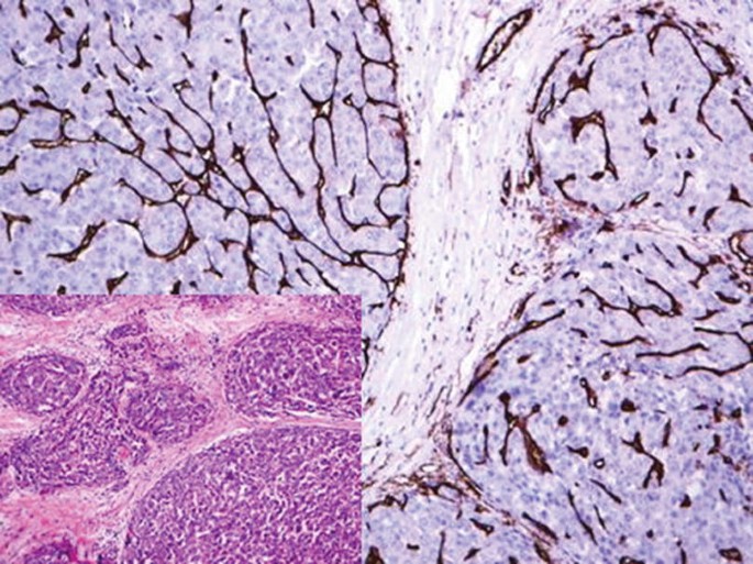 A photomicrograph highlights sinusoidal capillarization in hepatocellular carcinoma. An inset micrograph is provided at the bottom left.