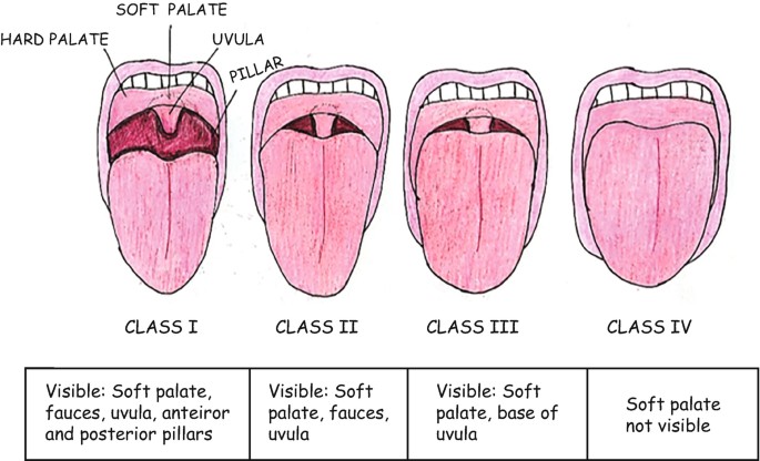 An illustration depicts 4 open mouths labeled classes 1 to 4. The parts labeled are hard and soft palates, uvula, and pillar. The text boxes under each describe the positions of the parts.