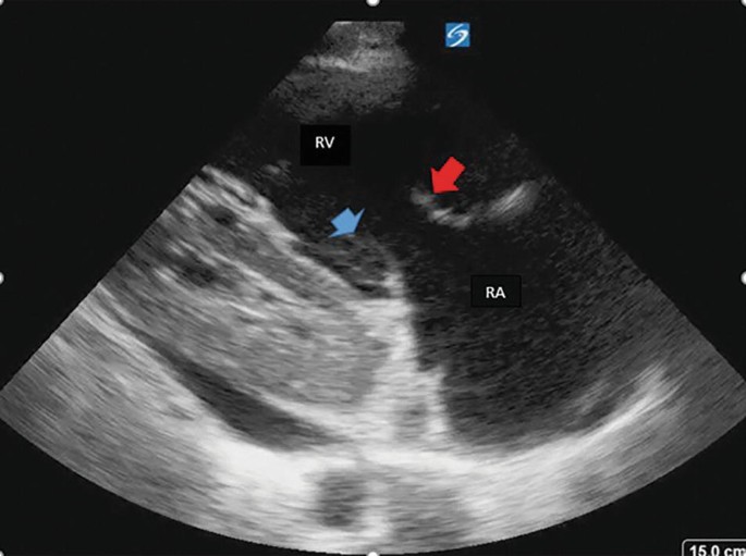 Tricuspid and Pulmonic Valve | SpringerLink