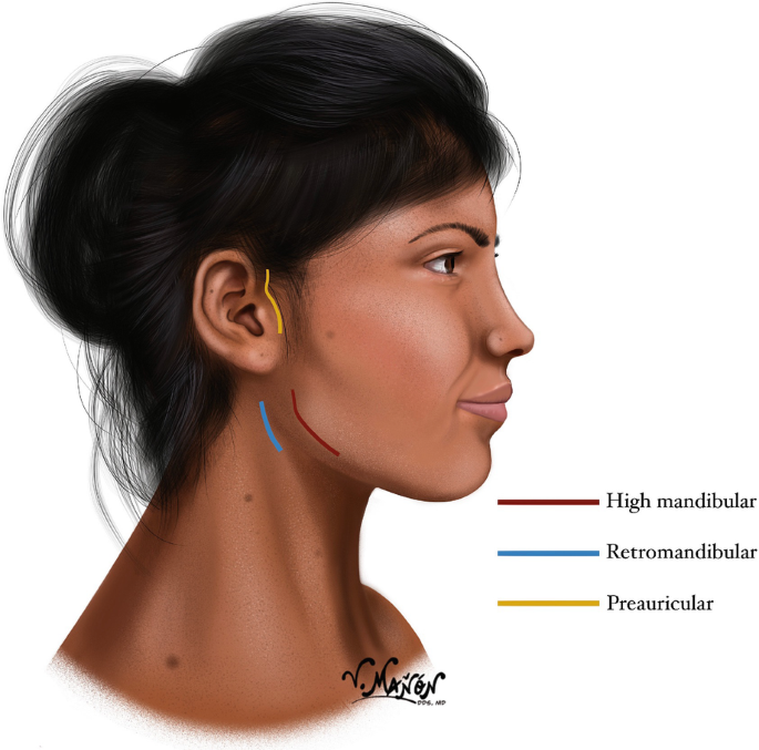 A diagram of the head of a patient. 3 surgical approaches labeled high mandibular, retromandibular, and preauricular are marked.