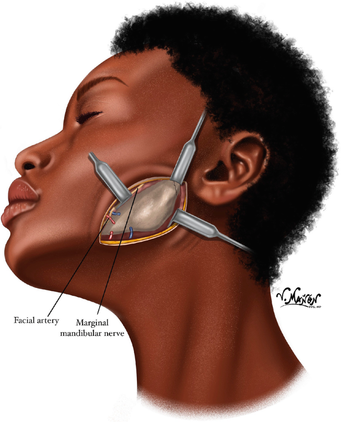 A diagram of the face of a patient presents high submandibular surgical approach. The facial artery and marginal mandibular nerve are labeled.