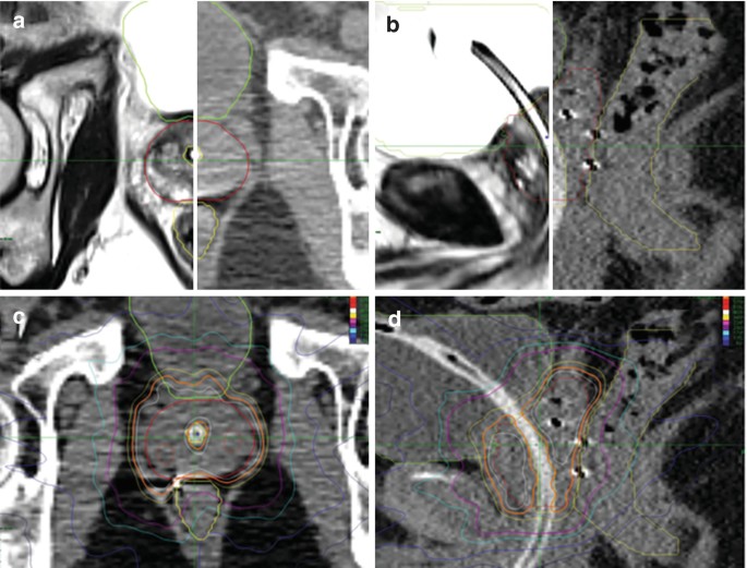 Prostatic Bed Prostate Cancer | SpringerLink