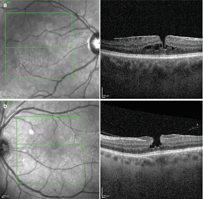 Surgical Management of Lamellar Macular Hole | SpringerLink