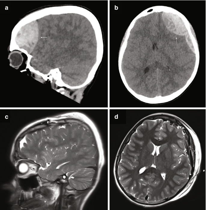 Traumatic Brain Injury in Pediatric Patients | SpringerLink