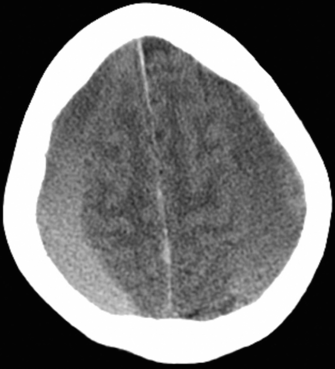 Neuroradiological Imaging for Traumatic Brain Injury | SpringerLink