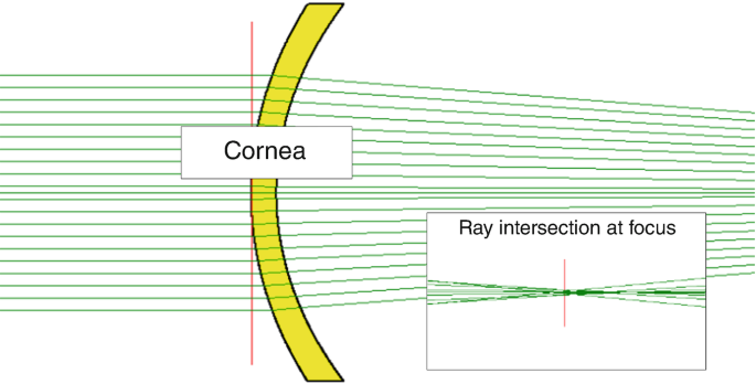 An illustration of the passage of light rays through the cornea, converging at a focus point, with detailed labels and a magnified section exhibiting the precise intersection at the focus.