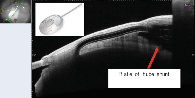 A scan of implanted tube shunt by CASIA 2. An arrow marks the plate of tube shunt.