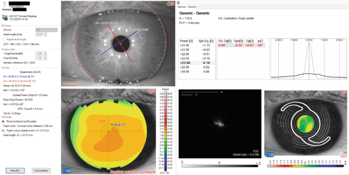 A screenshot of I O L calculation screen for an eye that underwent D S A E K surgery before cataract surgery. It includes iris frontal view, sagittal anterior curvature topography map, expected spherical equivalent and refraction data, focusing chart, P S F, and refractive error map.