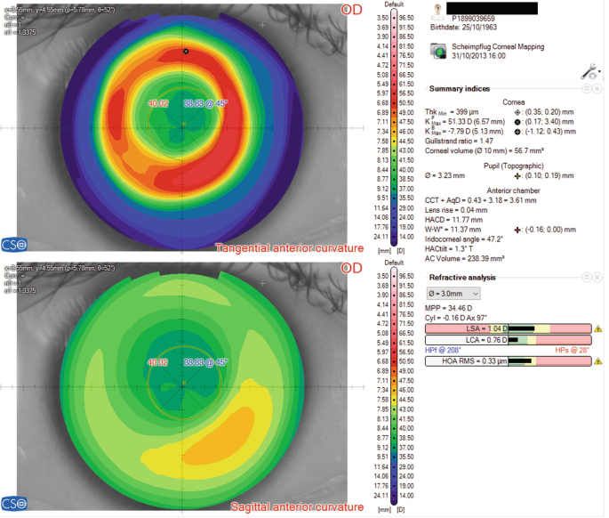 An illustration presents 2 corneal mapping labeled tangential and sagittal anterior curvature. The right part presents summary indices of cornea, pupil, and anterior chamber and refractive analysis.