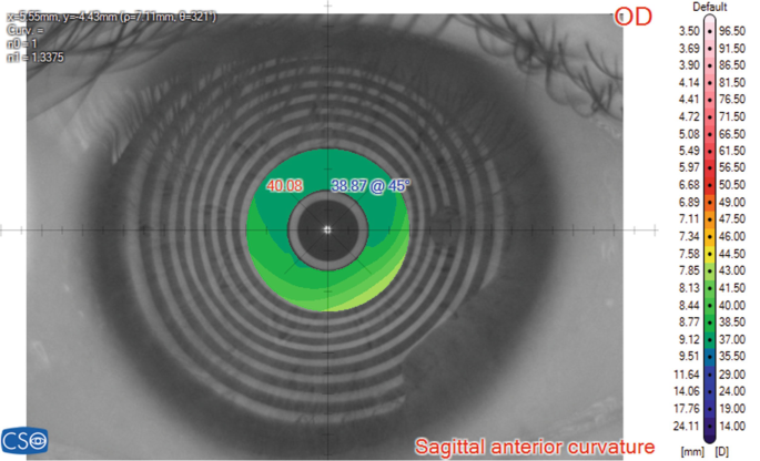 A sagittal curvature map of the cornea of a patient titled sagittal anterior curvature. The surgical transition zone is highlighted. Labels read 40.08 and 38.87 at 45 degrees.