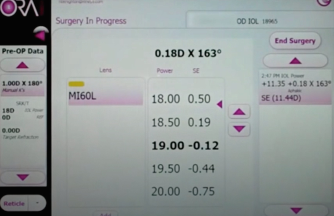 A screenshot of the screen presenting the user interface. The left panel presents pre operational data. The central panel is titled surgery in progress. Highlighted labels read 0.18 D times 163 degree, power 19.00, and S E negative 0.12.
