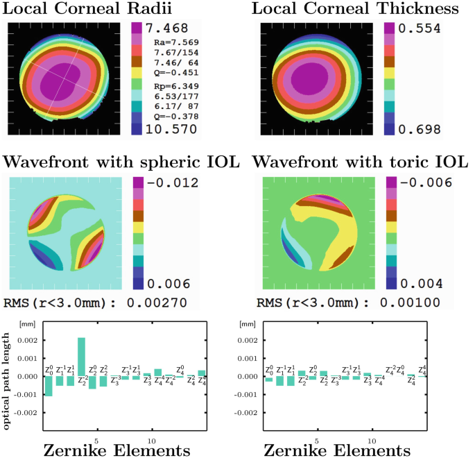 4 I O L structures of local corneal radii, local corneal thickness, wavefront with spheric I O L, and wavefront with toric I O L. In 2 bidirectional bar graphs plots optical path length versus Zernike elements, the highest path length is plotted for Z 2 raised to negative 2.