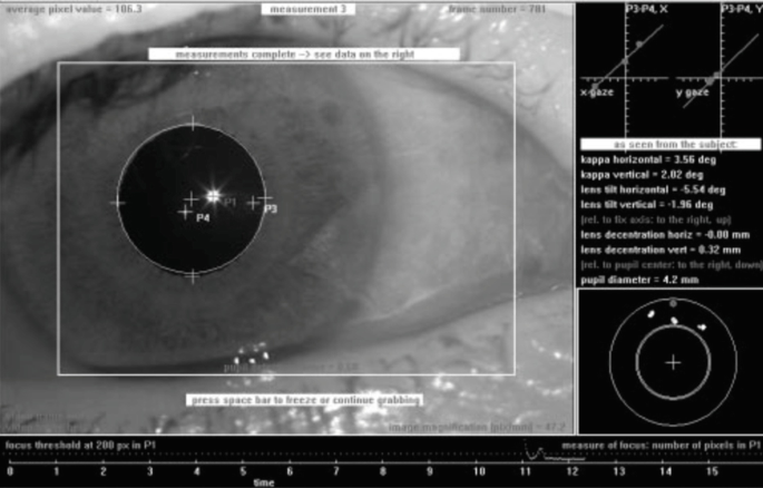 A Purkinje meter structure of an eye. The fields of the meter are focused on the pupil of the eye. The fields are formed using dots and circles. The results and dimensions are displayed on the left side of the structure.