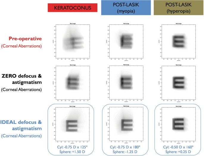 An illustration presents theoretical simulations in 3 columns labeled keratoconus, post LASIK myopia, and post LASIK hyperopia. The 3 rows are titled preoperative, zero defocus and astigmatism, and ideal defocus and astigmatism.