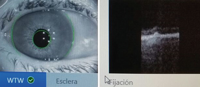 A photograph and a S S O C T scan of the eye of a patient. The S S O C T scan presents a macular scar.