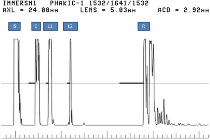 The signal is generated by an A-scan. Multiple tall and sharp spikes are formed initially. The length of the peaks progressively decreases with time.