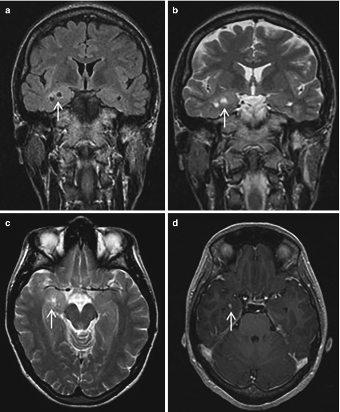 4 radiological scans. 1 and 2. Coronal F L A I R and T 2 scans present a lesion. 3. Axial T 2 scan presents a lesion and a cyst. 4. Post contrast T 1 scan presents a small enhancing nodule.