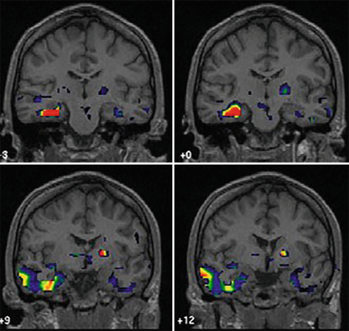 An illustration presents 4 S I S C O M E scans of the brain. Hyperperfusion in the right hippocampus and anterior temporal lobe is highlighted.